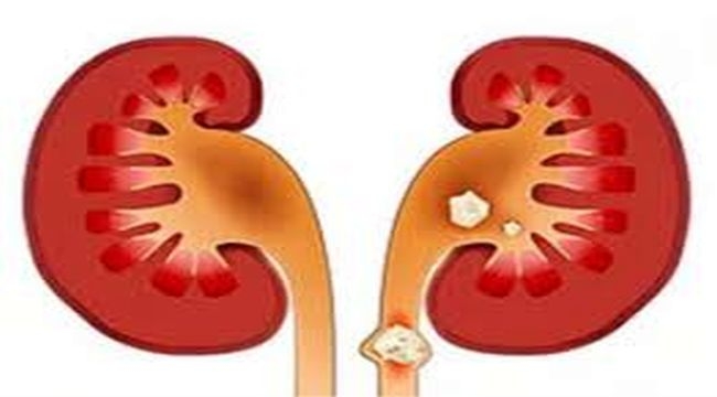 KÜÇÜK BÖBREK TAŞLARI AĞIR SONUÇLAR DOĞURABİLİYOR! 