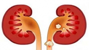 KÜÇÜK BÖBREK TAŞLARI AĞIR SONUÇLAR DOĞURABİLİYOR! 