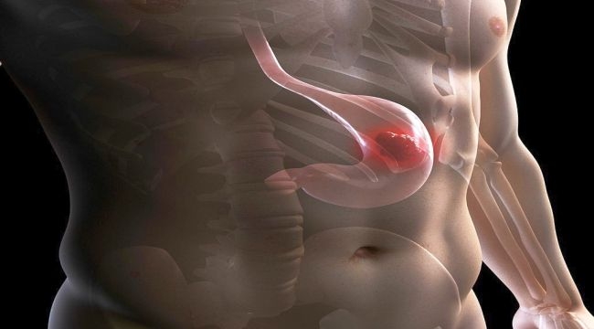 Mide Kanserini Tetikleyen Etkenler