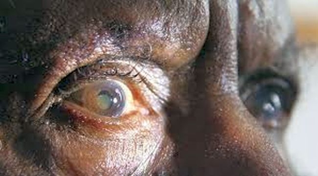 Katarakt Ameliyatı Bunama Riskini Azaltabilir...