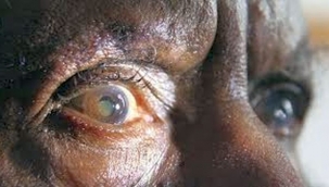 Katarakt Ameliyatı Bunama Riskini Azaltabilir...