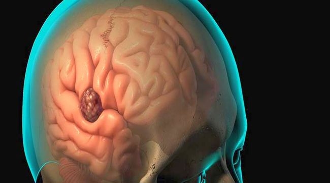 En önemli gelişmeler beyin tümörlerinin tanı ve tedavisinde yaşanıyor 